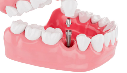 Implantes Dentários