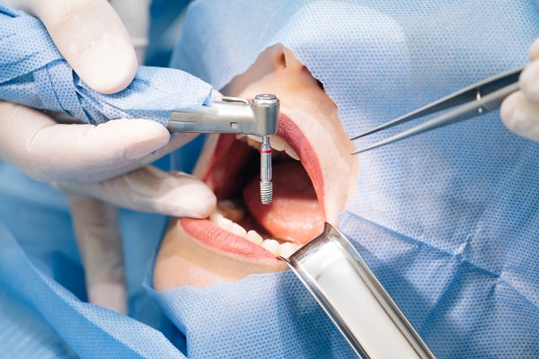 Implantes dentários